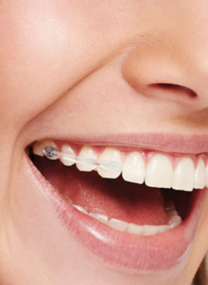 Carriere® Braces