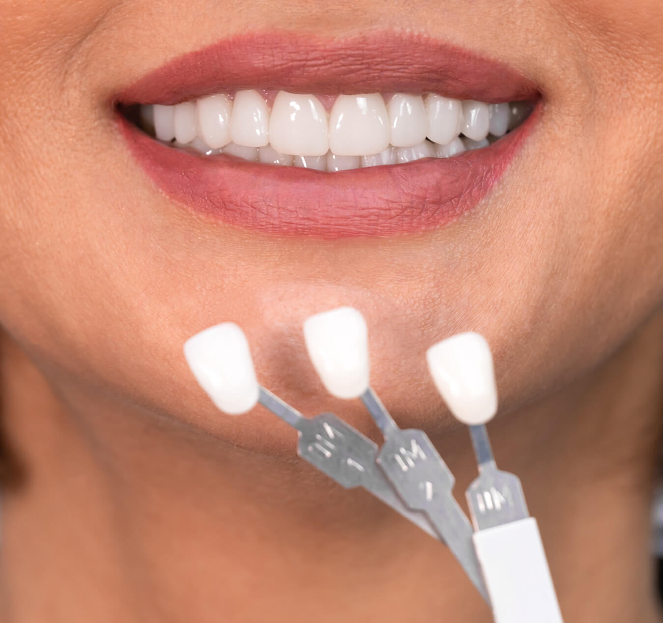 What Are Dental Veneers? What Are Dental Veneers?