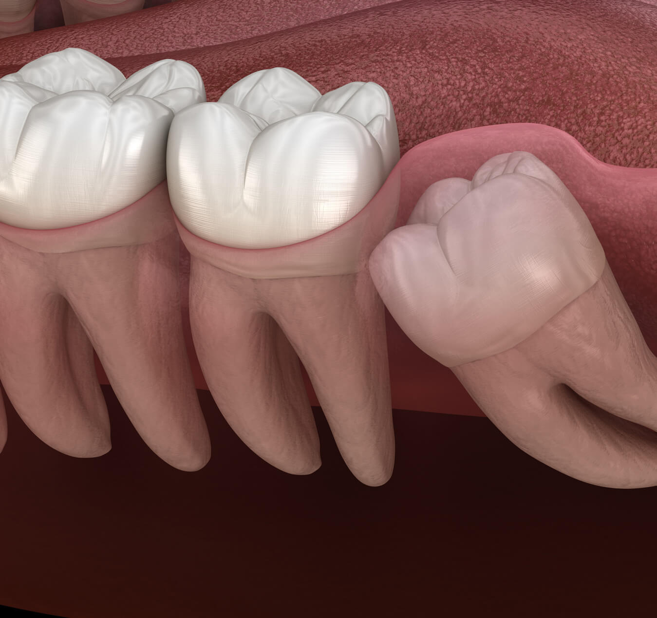 Wisdom Teeth Removal Wisdom Teeth Removal