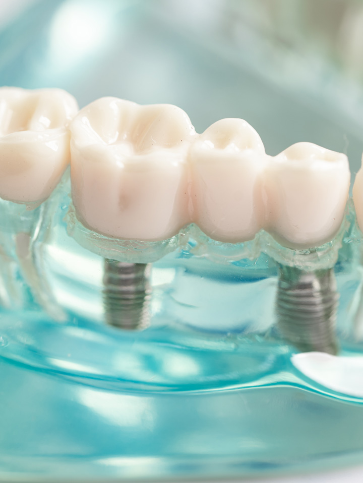 Dental Implants Permanent, natural-looking replacements for missing teeth. Dental Implants Permanent, natural-looking replacements for missing teeth.