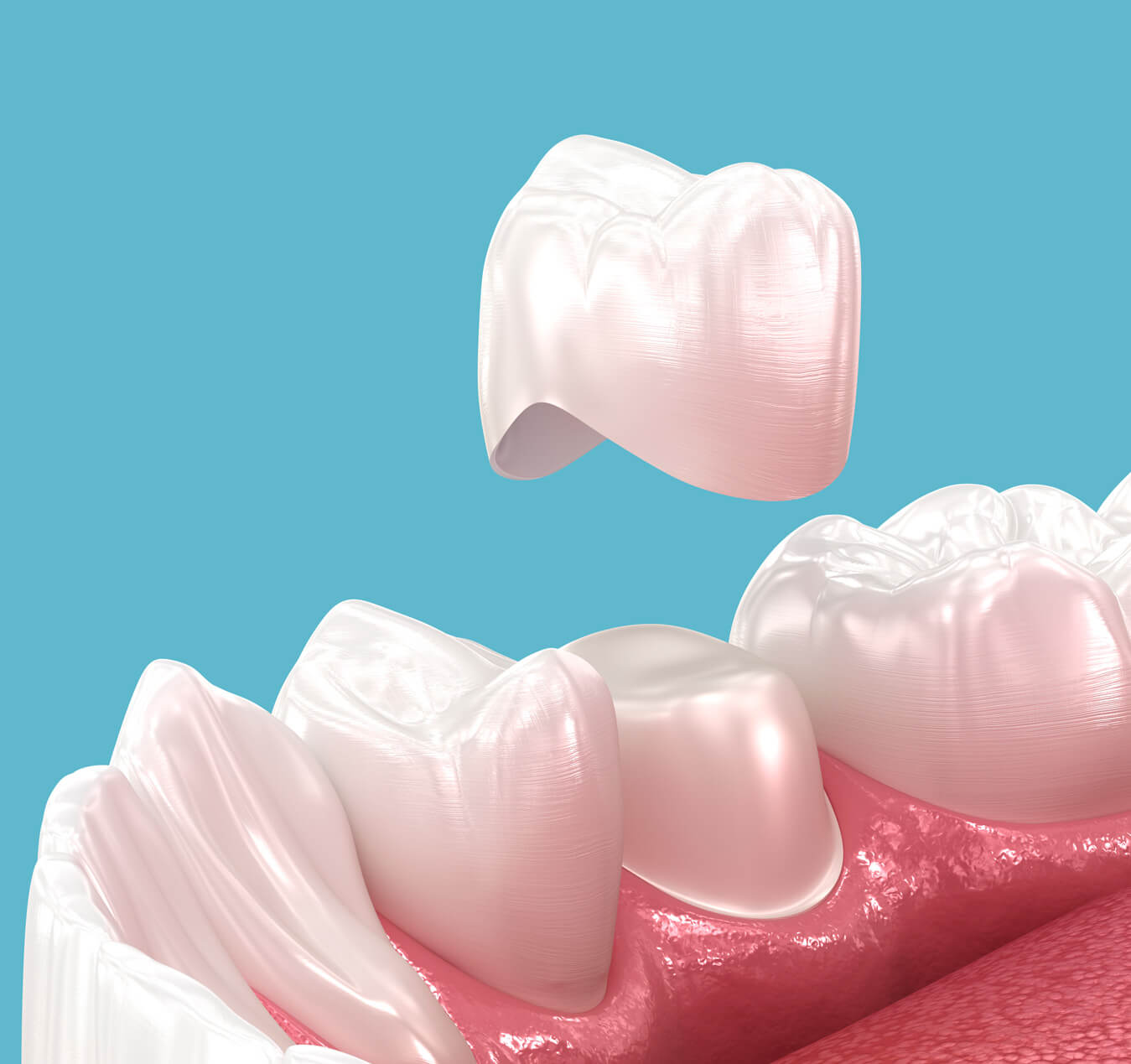 What Are Dental Crowns? What Are Dental Crowns?