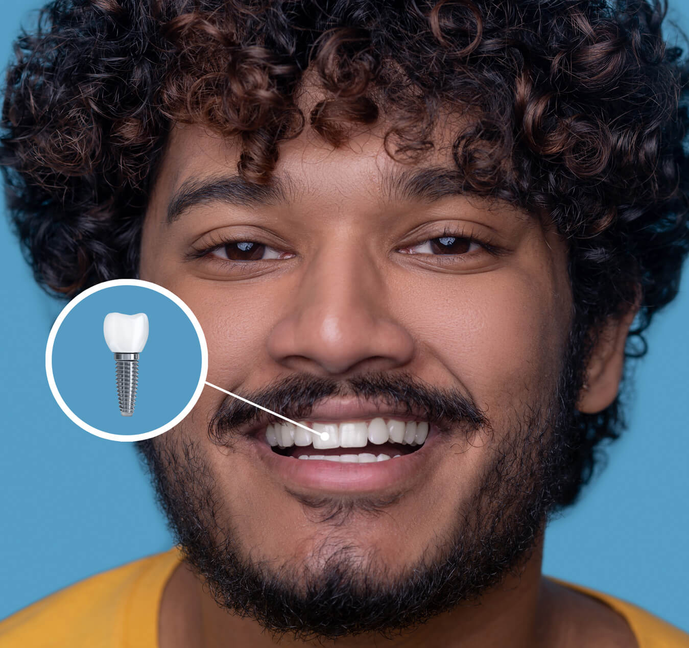 What Are Dental Implants? What Are Dental Implants?