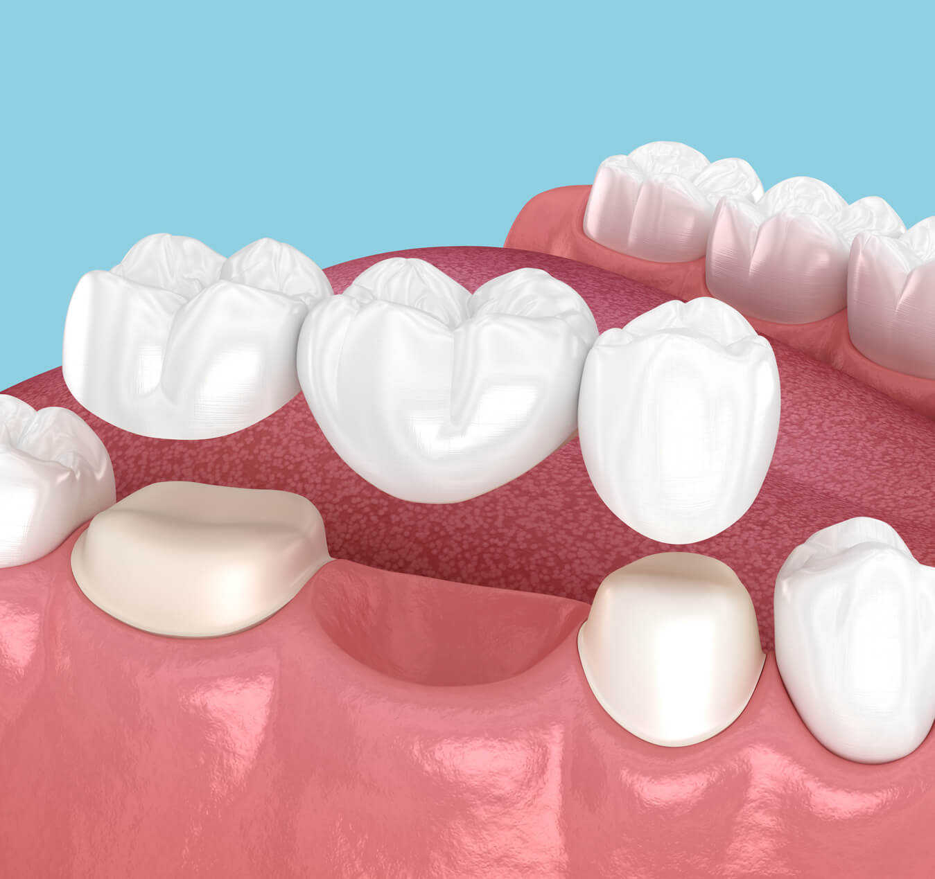 How Do Dental Bridges Work? How Do Dental Bridges Work?