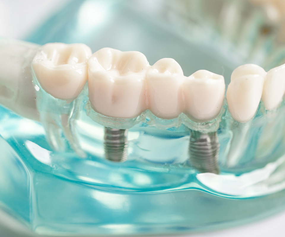Dental Implants, Chichester Dental Implants, Chichester