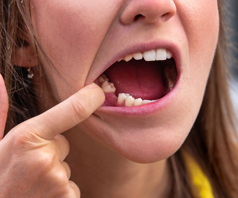 I Have a Missing Tooth – What Are My Options?