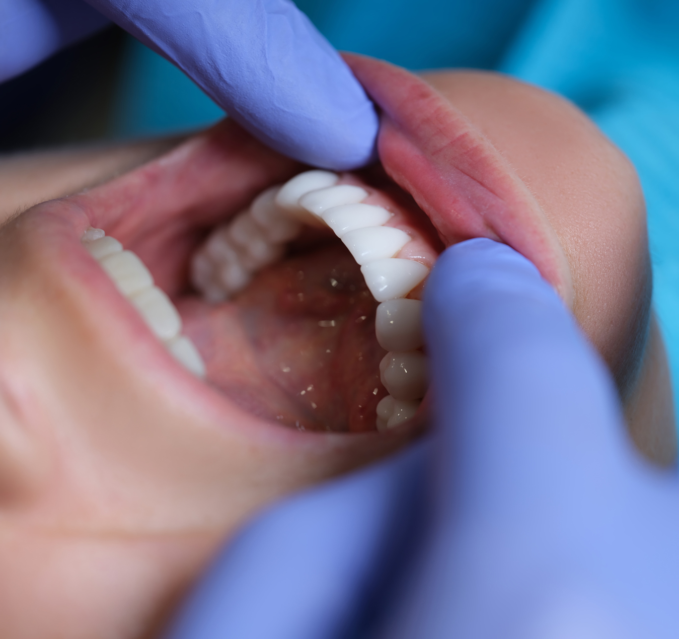 Can AirFlow Help With Yellow Teeth? Can AirFlow Help With Yellow Teeth?