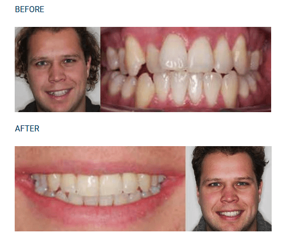 invisalign braces