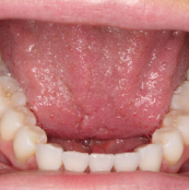 Lower teeth