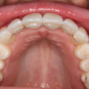Upper teeth