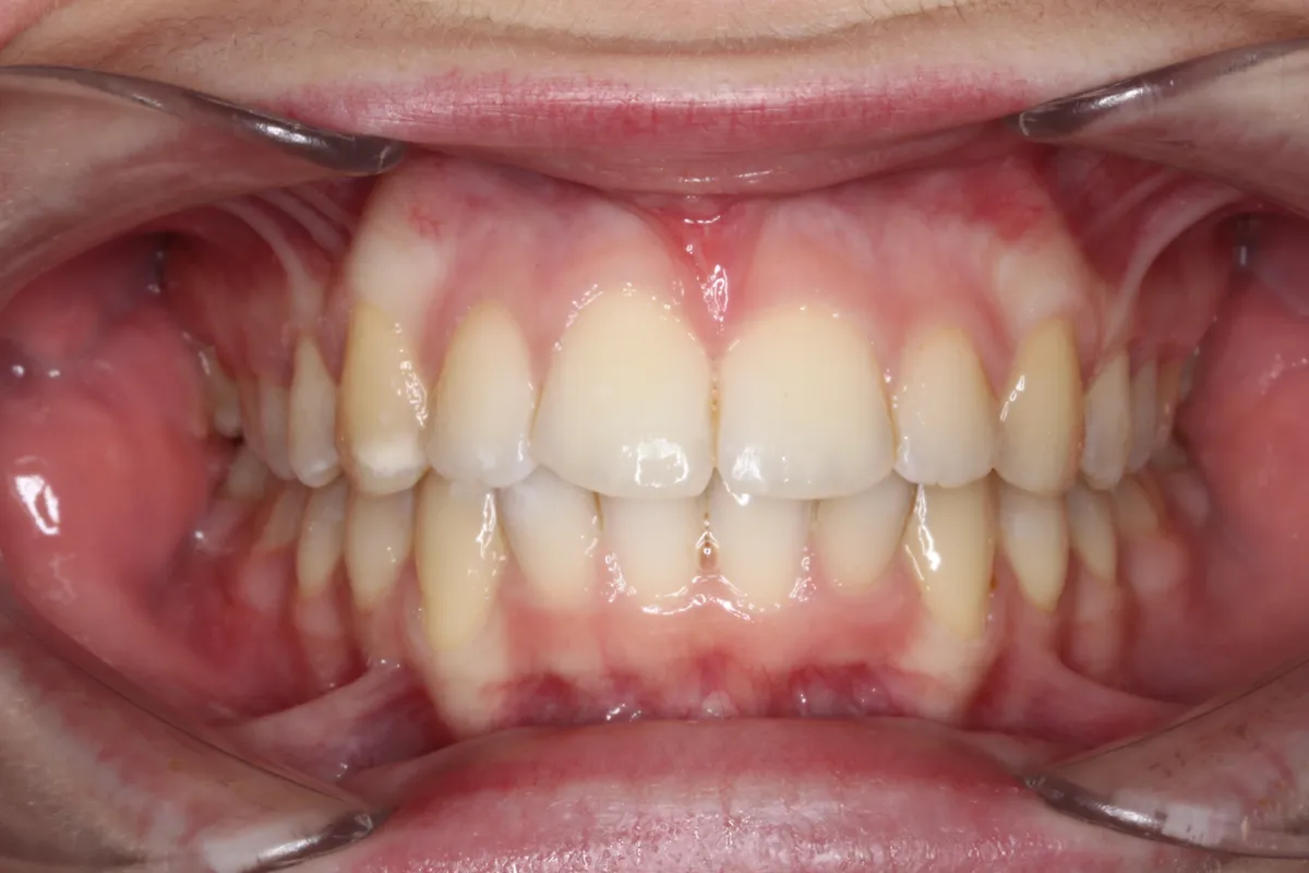 Before and after orthodontic treatment at Pallant Advanced Dentistry
