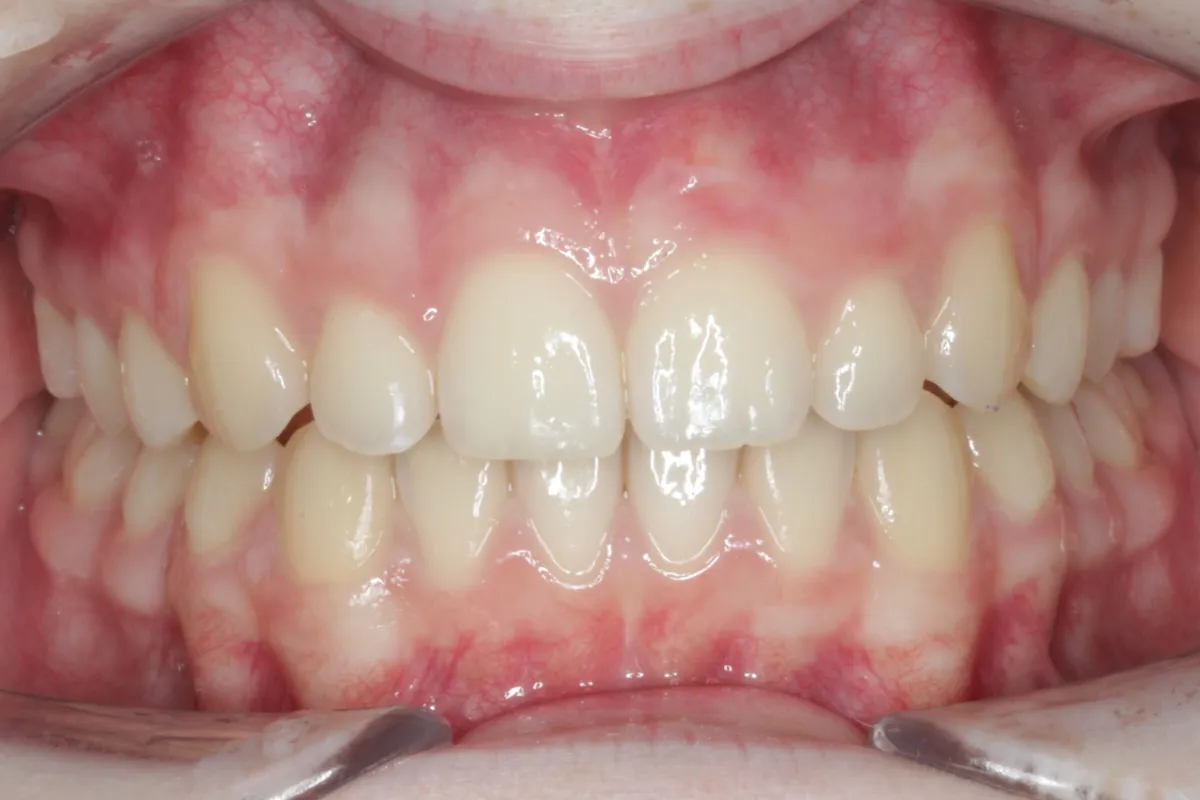 Before and after orthodontic treatment at Pallant Advanced Dentistry