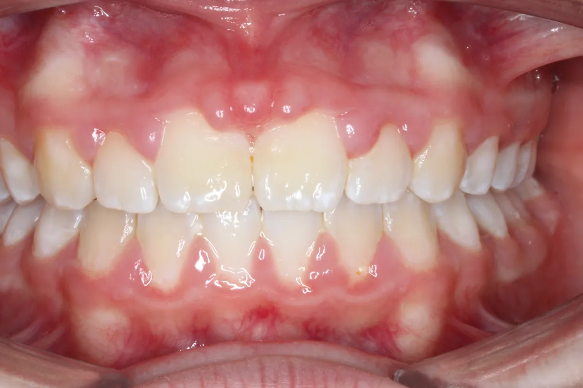Before and after orthodontic treatment at Pallant Advanced Dentistry
